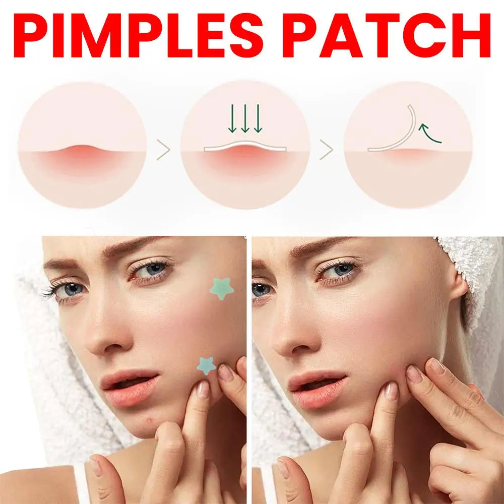200pcs Star Pimple Patch
