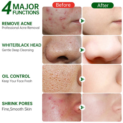 Acne Treatment Facial Mask